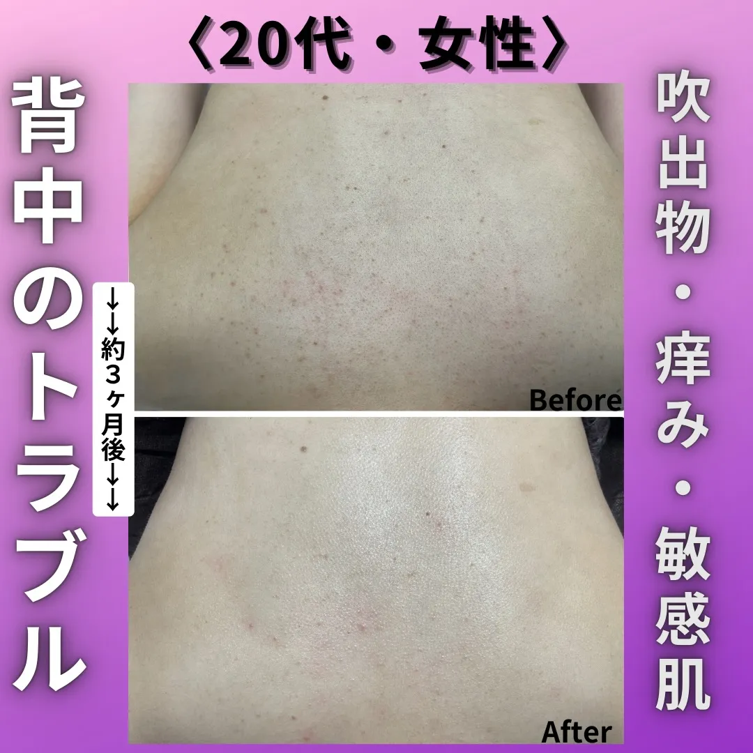 先日嬉しいお声を頂きましたお客様のお背中の症例です📣